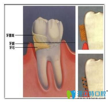 牙結(jié)石的危害你知道嗎？告別牙結(jié)石可以用這7種方法