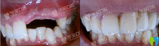 濰坊華貝口腔種植牙術前術后效果對比圖