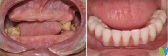 全口牙缺失怎么辦？合肥美奧口腔全口種植牙案例效果賞析