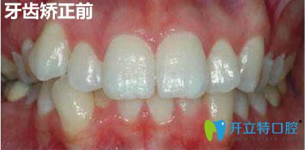 在上海馬瀧齒科做隱適美牙齒矯正12個(gè)月啦,來(lái)說(shuō)下我的感受