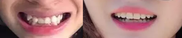 ?虎牙前突 大連沙醫(yī)生口腔金屬托槽矯正讓我實(shí)現(xiàn)整牙夢(mèng)想
