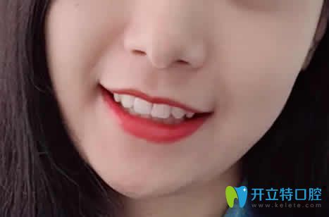 我在廈門(mén)天使口腔做牙齒矯正18個(gè)月照片