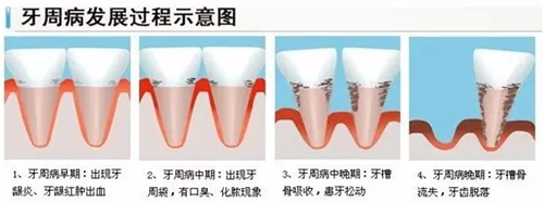 整牙會導(dǎo)致牙齦萎縮嗎？整牙后牙齦萎縮怎么辦？