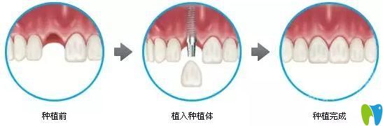 清遠(yuǎn)中大口腔曹銀光科普即刻種植牙技術(shù)優(yōu)勢(shì)