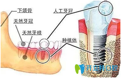 常用的人工種植牙技術(shù)有哪些？請看種植牙技術(shù)排名	