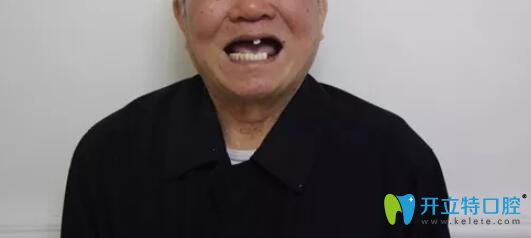 廣州柏德牙科87歲老人讓廣州柏德口腔薛啟明做了半口種植牙后來(lái)談感受