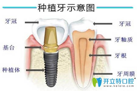 重慶美奧口腔正規(guī)可靠嗎?我做完種植牙來(lái)評(píng)價(jià)醫(yī)院收費(fèi)怎樣