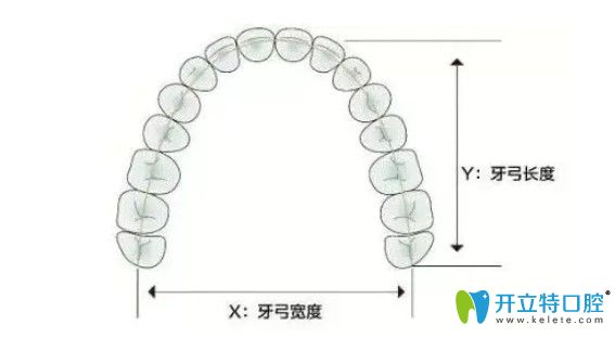 李可君醫(yī)生給科普牙齒矯正的擴弓器有什么作用