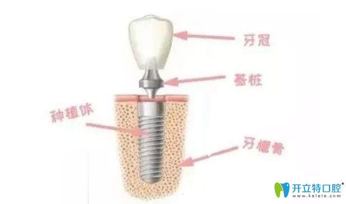 耿遠(yuǎn)明醫(yī)生告訴你種植牙結(jié)構(gòu)