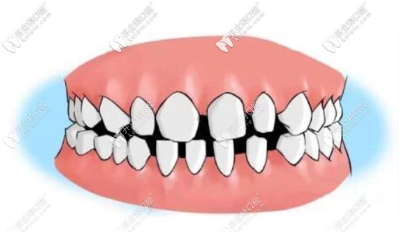 我的牙縫很大，到底需不需要補(bǔ)呀