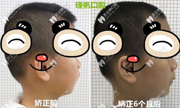 7歲小孩換牙后成了齙牙,戴活動矯正器半年后終于初見成效