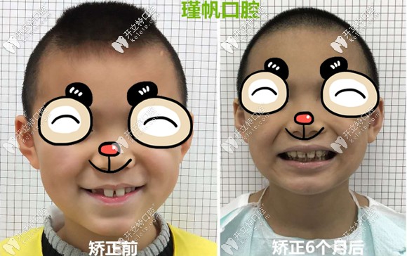 小孩換牙后齙牙矯正前后效果