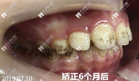 矯治6個(gè)月后的牙齒側(cè)貌圖