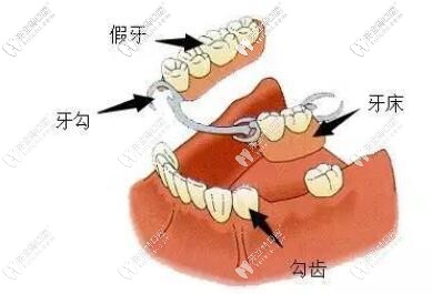 活動(dòng)假牙圖示