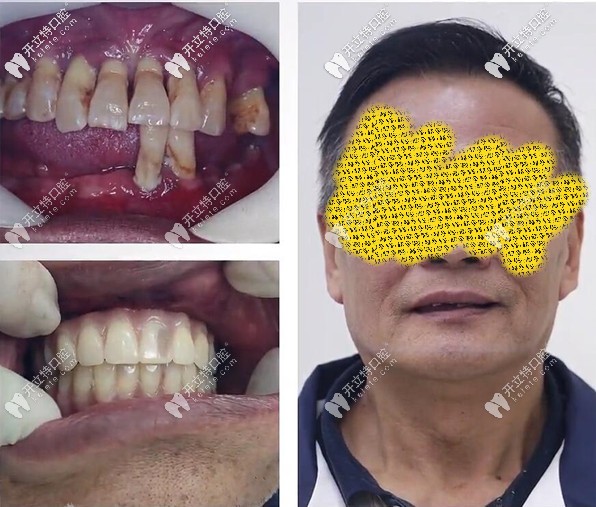 廣州柏德牙科我做全口allon6即刻種植牙用了1小時(shí),過(guò)程和種牙價(jià)格我得嘮嘮