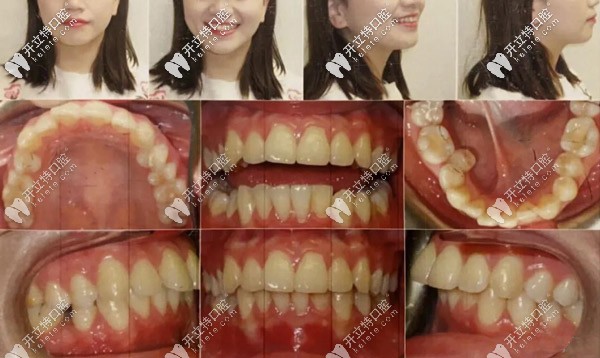 正面、側(cè)面照，記錄牙齒的變化情況
