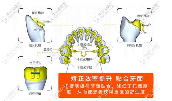 舌側(cè)矯正