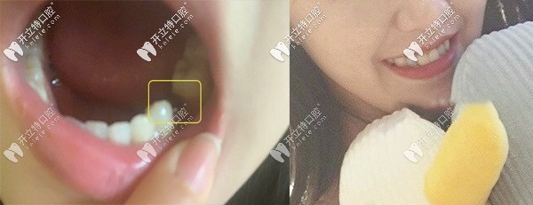 在昆明德韓口腔做韓系進口種植牙的真實評價來了