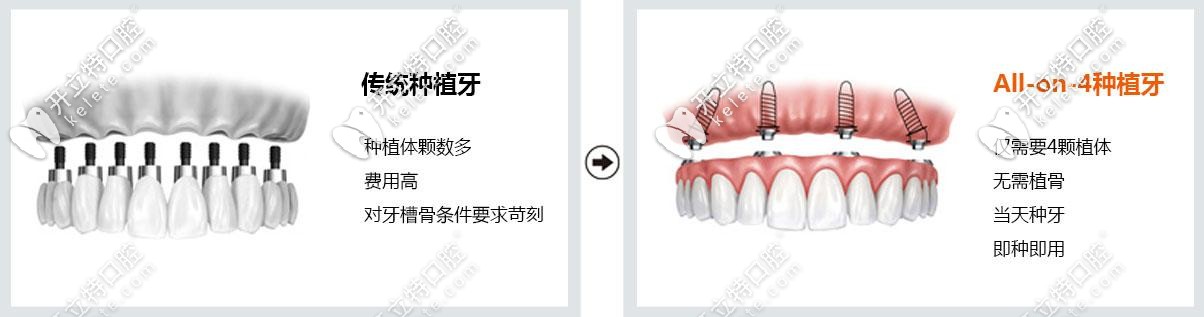 All-on-4種植技術(shù)