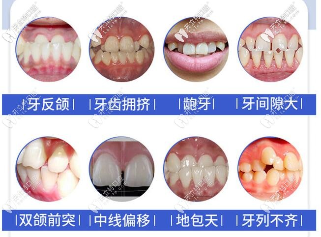 想知道重慶時(shí)代天使矯正價(jià)格嗎？世紀(jì)美奧口腔活動(dòng)價(jià)19800