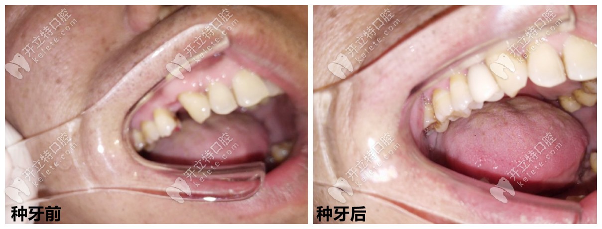 石家莊中諾口腔種牙好嗎？從種牙案例、醫(yī)生技術(shù)來看！