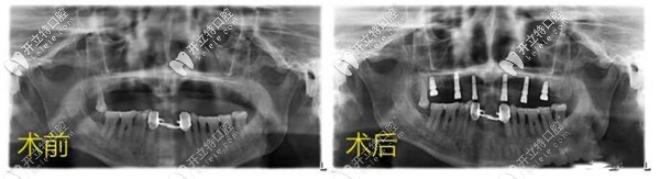 揭秘昆明汪大爺做allon4半口種植4顆牙的詳細步驟